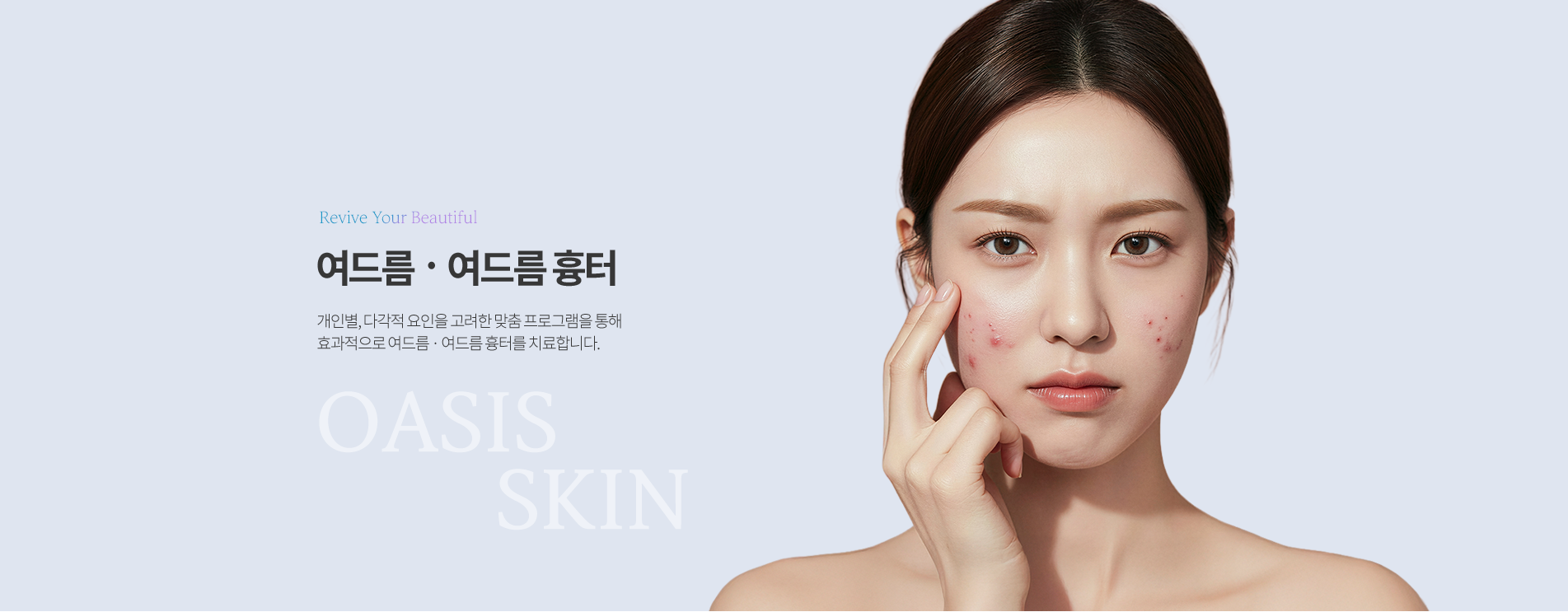 여드름·여드름흉터 상단