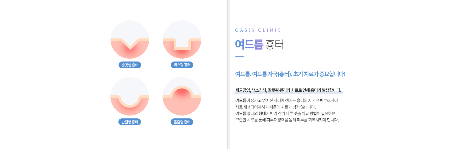 여드름흉터 종류