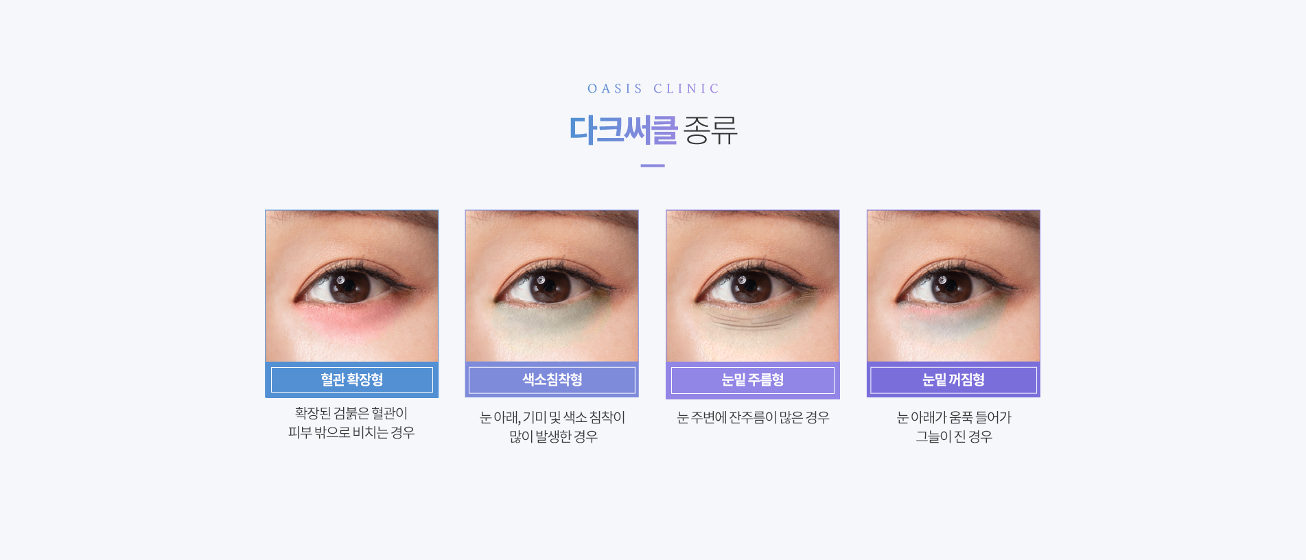 다크써클 종류