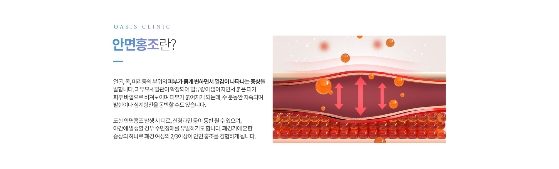 안면홍조란?