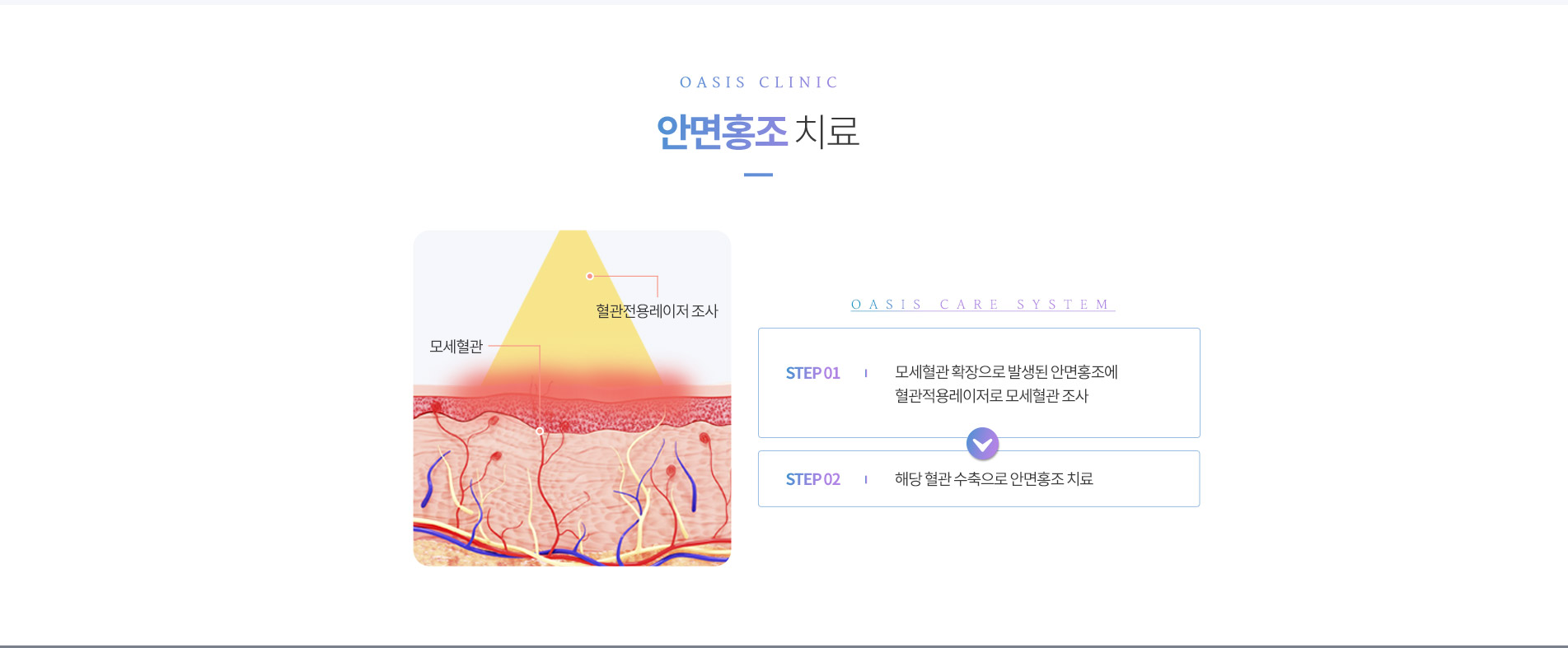안면홍조 치료