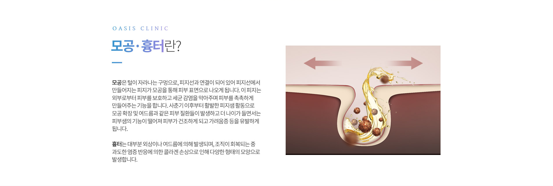 모공흉터란?
