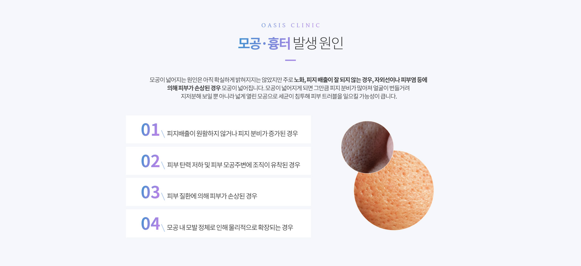 모공흉터 발생원인