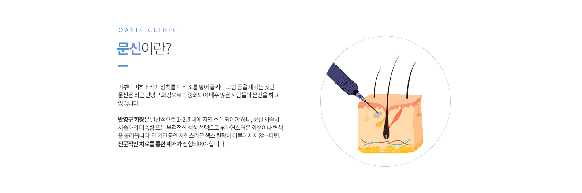 문신제거란?