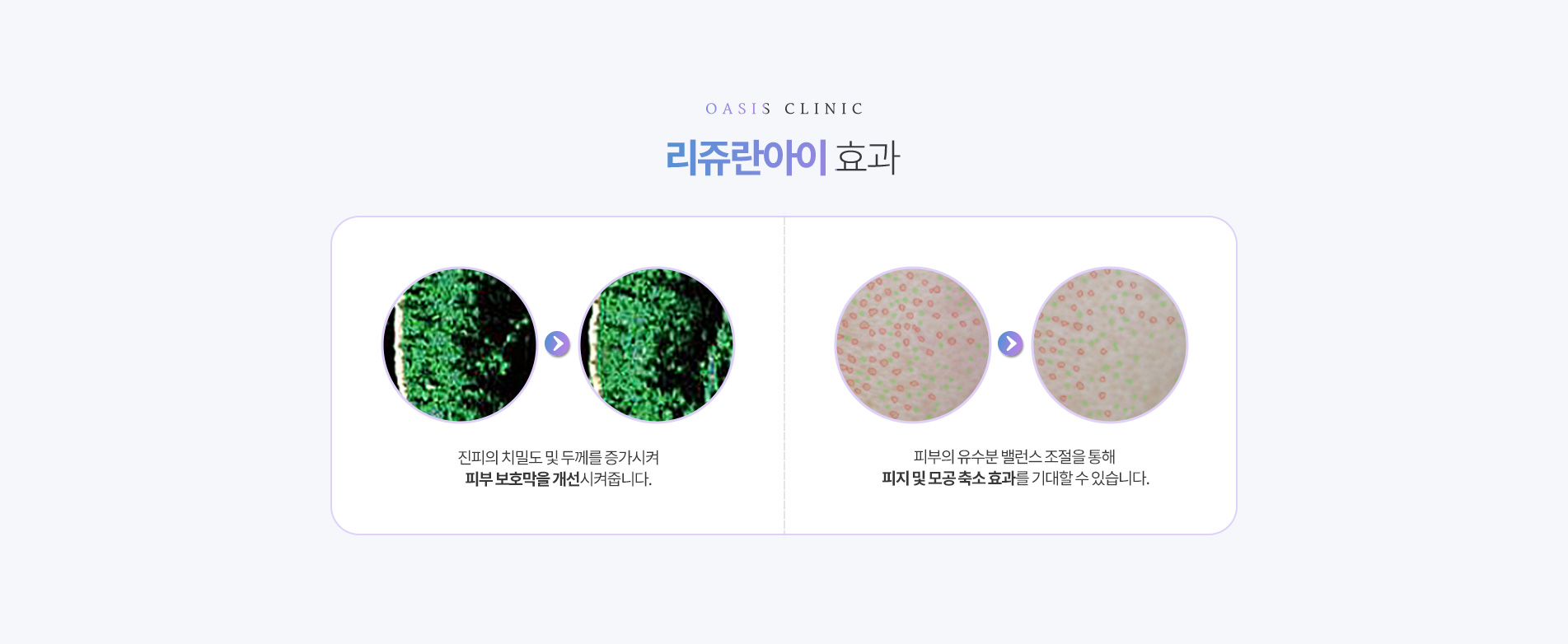 리쥬란아이 효과