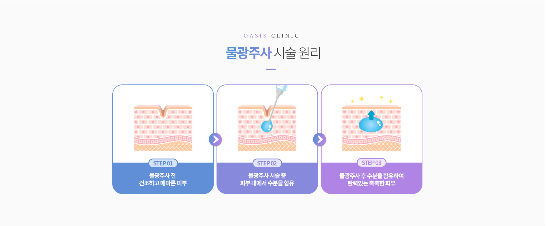 물광주사 시술원리